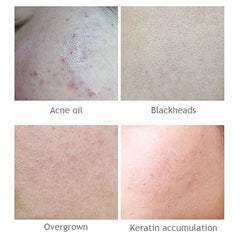 AICHUN BEAUTY  Salicylic Acid Purifying Shrink Pores Exfoliation Anti-Acne Face Serum - 30ml