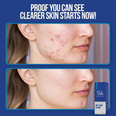 Wiki Special Anti Acne Serum - 30ml