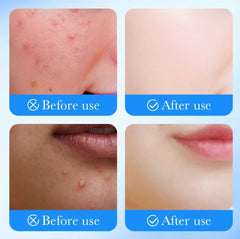 Sadoer Remove Face Acne 36 Patches